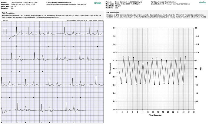 ECG PVCs